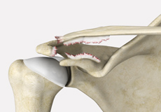 AC Joint Separation