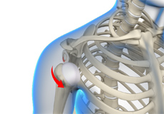 Anterior Shoulder Instability