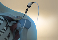 Arthroscopic Acromioplasty