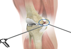 Arthroscopic Reconstruction of the Knee for Ligament Injuries