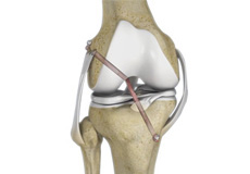 Benefits of Arthroscopic Surgery