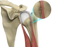 Bicep Tendon Rupture at Shoulder