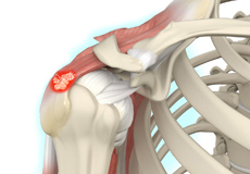 Rotator Cuff Calcification