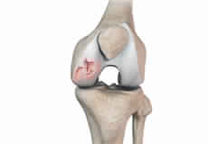 Chondral or Articular Cartilage Defects