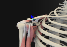 Distal Clavicle Excision