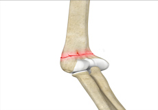 Distal Humerus Fractures of the Elbow