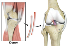 Hamstring Allograft