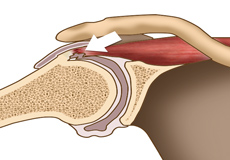 Internal Impingement of the Shoulder