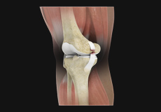 Knee Ligament Reconstruction