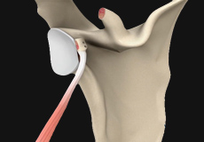 Latarjet Procedure