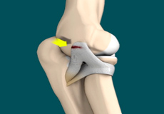 Lateral Ulnar Collateral Ligament Injuries (Elbow)