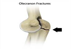 ORIF of the Olecranon Fractures