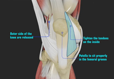 Patellofemoral Realignment