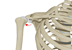 Posterior Shoulder Instability