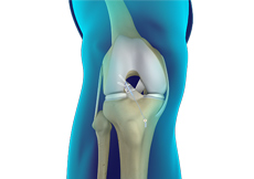ACL Repair