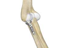 Radial Head Fractures of the Elbow