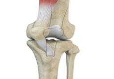 Recurrent Patella Dislocation