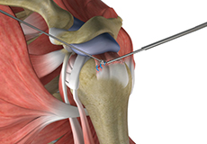 Rotator Cuff Pain