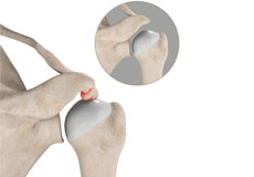 Subacromial Decompression