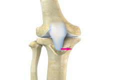 Tibial Tubercle Osteotomy