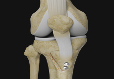 Tibial Tubercle Transfer